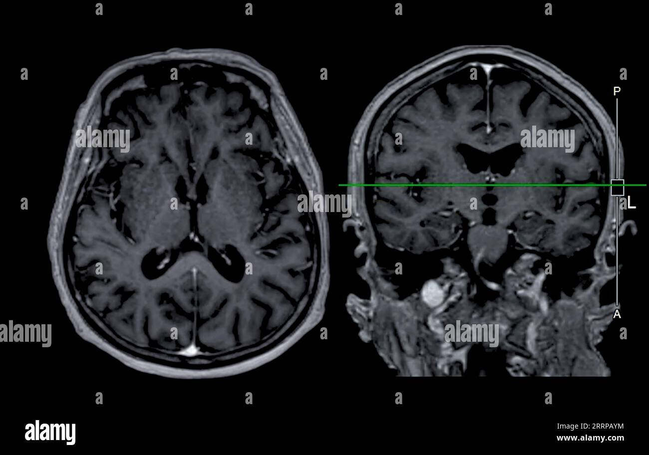 Imagerie cérébrale IRM vue axiale et frontale avec ligne de référence pour détecter les maladies cérébrales telles que les accidents vasculaires cérébraux, les tumeurs cérébrales et les infections. Banque D'Images