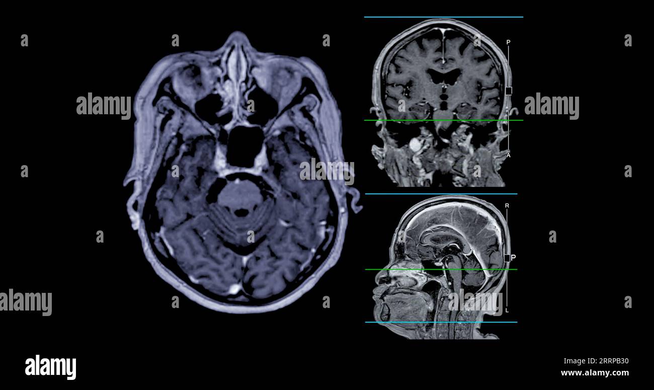 IRM cérébrale vue axiale, coronale et sagittale avec ligne de référence pour détecter les maladies cérébrales telles que les accidents vasculaires cérébraux, les tumeurs cérébrales et les infections. Banque D'Images