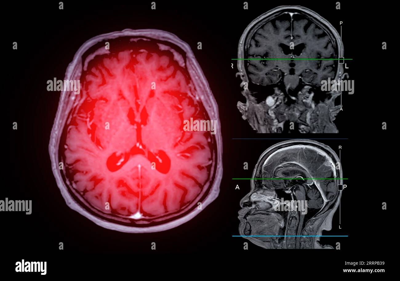 IRM cérébrale vue axiale, coronale et sagittale avec ligne de référence pour détecter les maladies cérébrales telles que les accidents vasculaires cérébraux, les tumeurs cérébrales et les infections. Banque D'Images