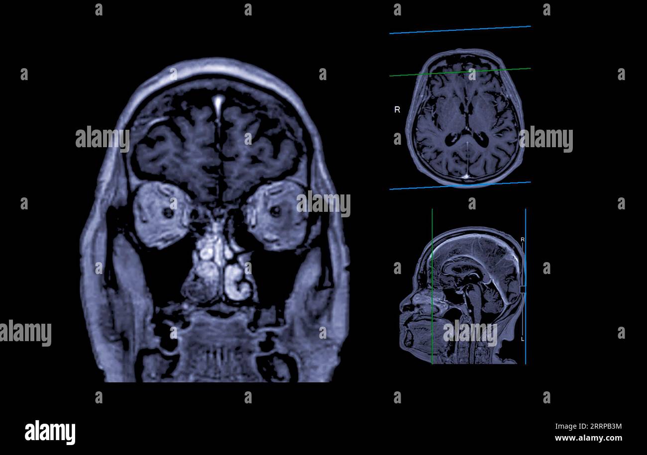 IRM cérébrale vue axiale, coronale et sagittale avec ligne de référence pour détecter les maladies cérébrales telles que les accidents vasculaires cérébraux, les tumeurs cérébrales et les infections. Banque D'Images