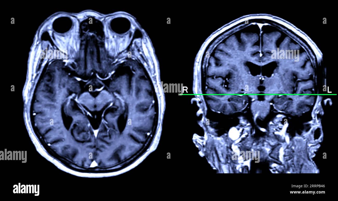 Imagerie cérébrale IRM vue axiale et frontale avec ligne de référence pour détecter les maladies cérébrales telles que les accidents vasculaires cérébraux, les tumeurs cérébrales et les infections. Banque D'Images