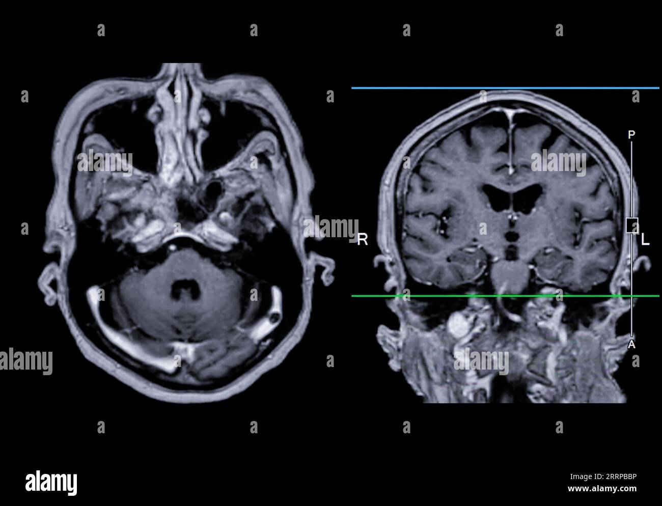 Imagerie cérébrale IRM vue axiale et frontale avec ligne de référence pour détecter les maladies cérébrales telles que les accidents vasculaires cérébraux, les tumeurs cérébrales et les infections. Banque D'Images