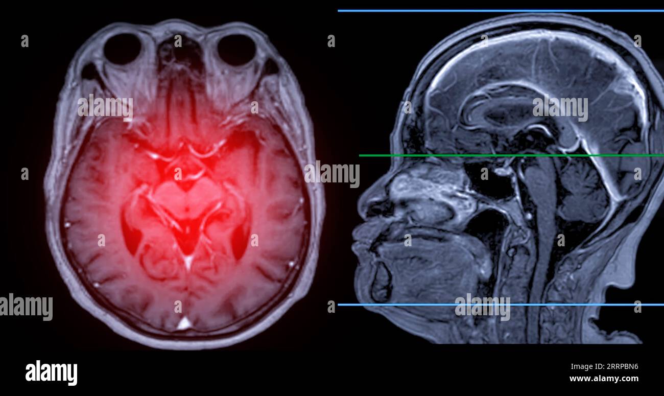 Imagerie cérébrale IRM vue axiale et sagittale avec ligne de référence pour détecter les maladies cérébrales telles que les accidents vasculaires cérébraux, les tumeurs cérébrales et les infections. Banque D'Images
