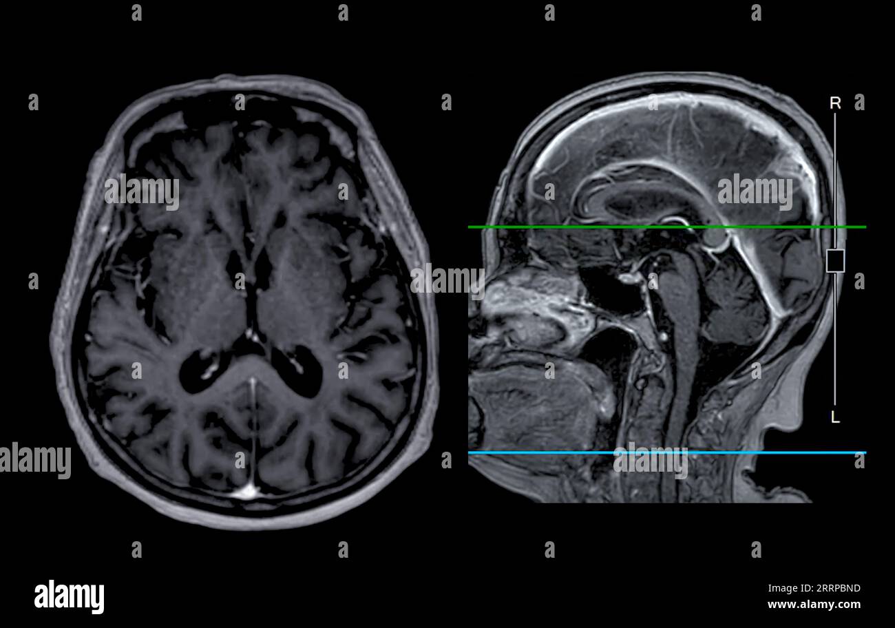 Imagerie cérébrale IRM vue axiale et sagittale avec ligne de référence pour détecter les maladies cérébrales telles que les accidents vasculaires cérébraux, les tumeurs cérébrales et les infections. Banque D'Images