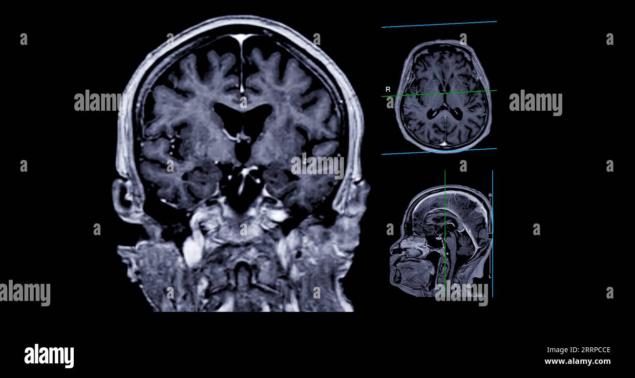 IRM cérébrale vue axiale, coronale et sagittale avec ligne de référence pour détecter les maladies cérébrales telles que les accidents vasculaires cérébraux, les tumeurs cérébrales et les infections. Banque D'Images