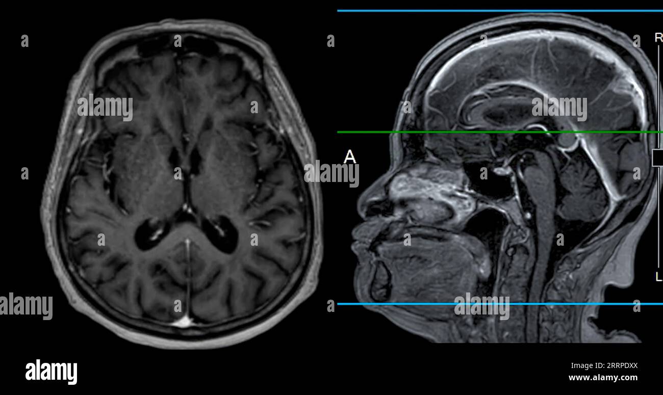 Imagerie cérébrale IRM vue axiale et sagittale avec ligne de référence pour détecter les maladies cérébrales telles que les accidents vasculaires cérébraux, les tumeurs cérébrales et les infections. Banque D'Images