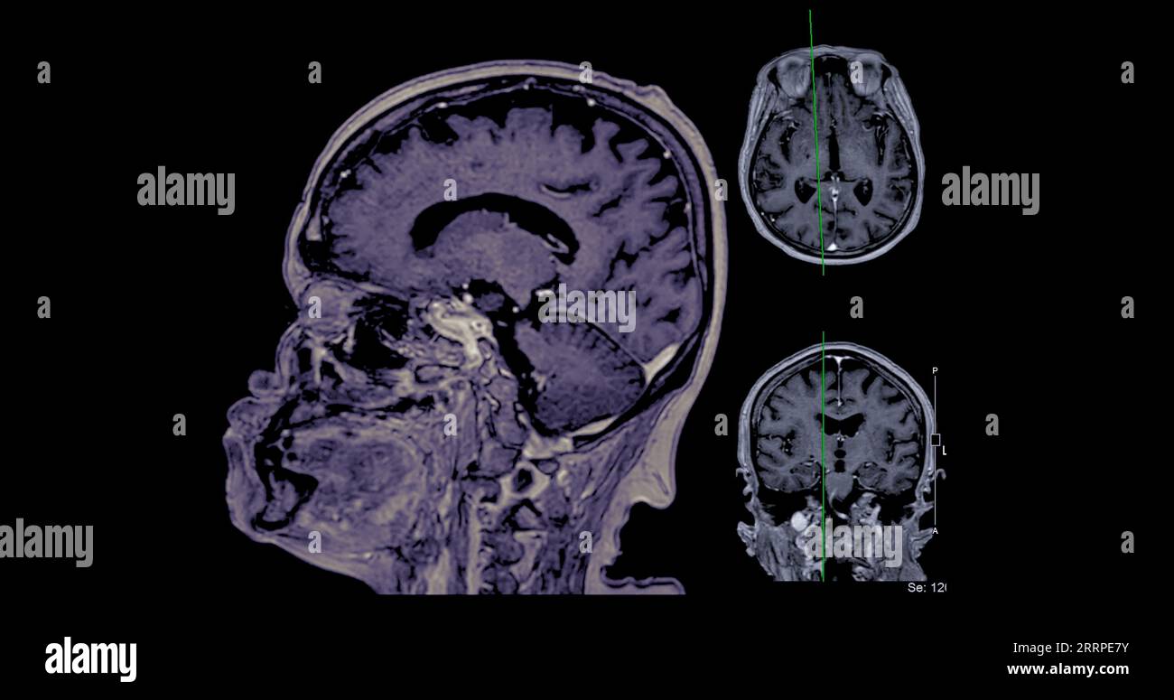 IRM cérébrale vue axiale, coronale et sagittale avec ligne de référence pour détecter les maladies cérébrales telles que les accidents vasculaires cérébraux, les tumeurs cérébrales et les infections. Banque D'Images