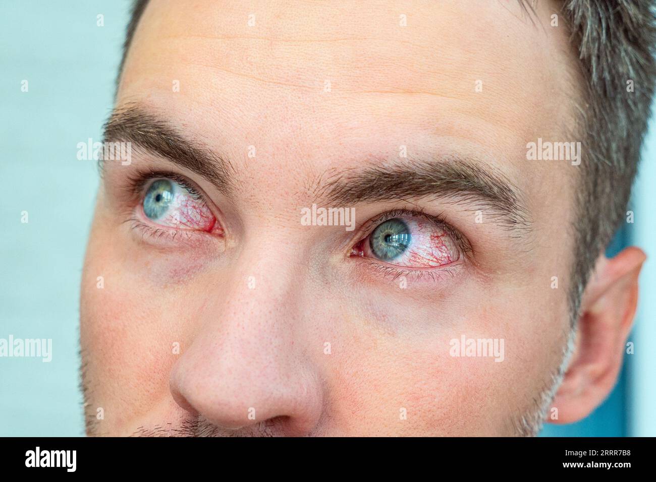 Gros plan de deux yeux de sang rouge agacé de mâle affecté par la conjonctivite ou après la mouche, allergie de couleur. Concept de santé, maladie et traitement. Banque D'Images