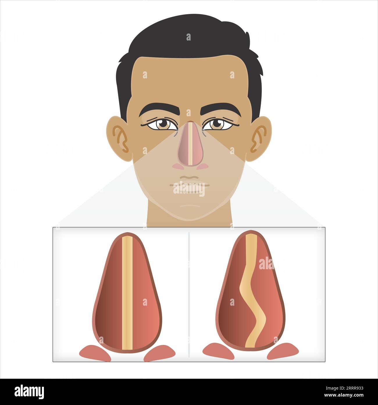 Lésion du cartilage nasal cassé illustration Banque D'Images