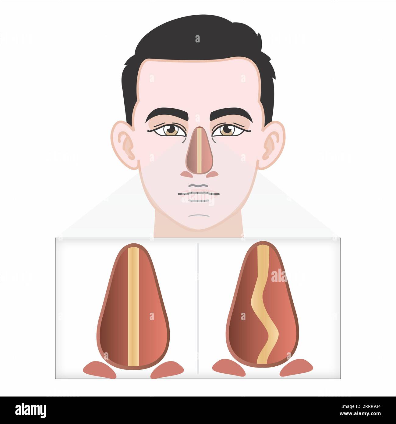 Lésion du cartilage nasal cassé illustration Banque D'Images