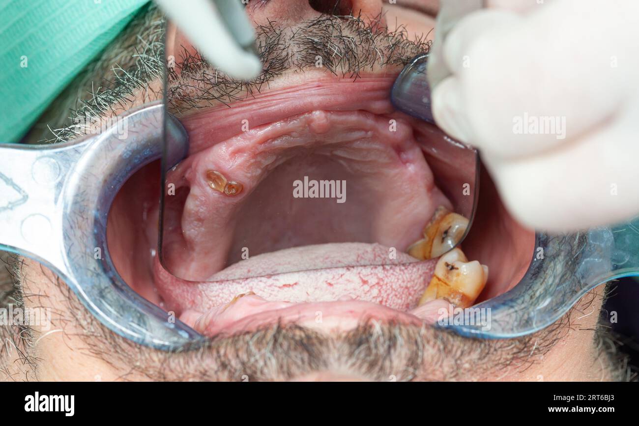 Dents pourries lors de l'inspection avec écarteur pour la conception d'implants dentaires. Banque D'Images