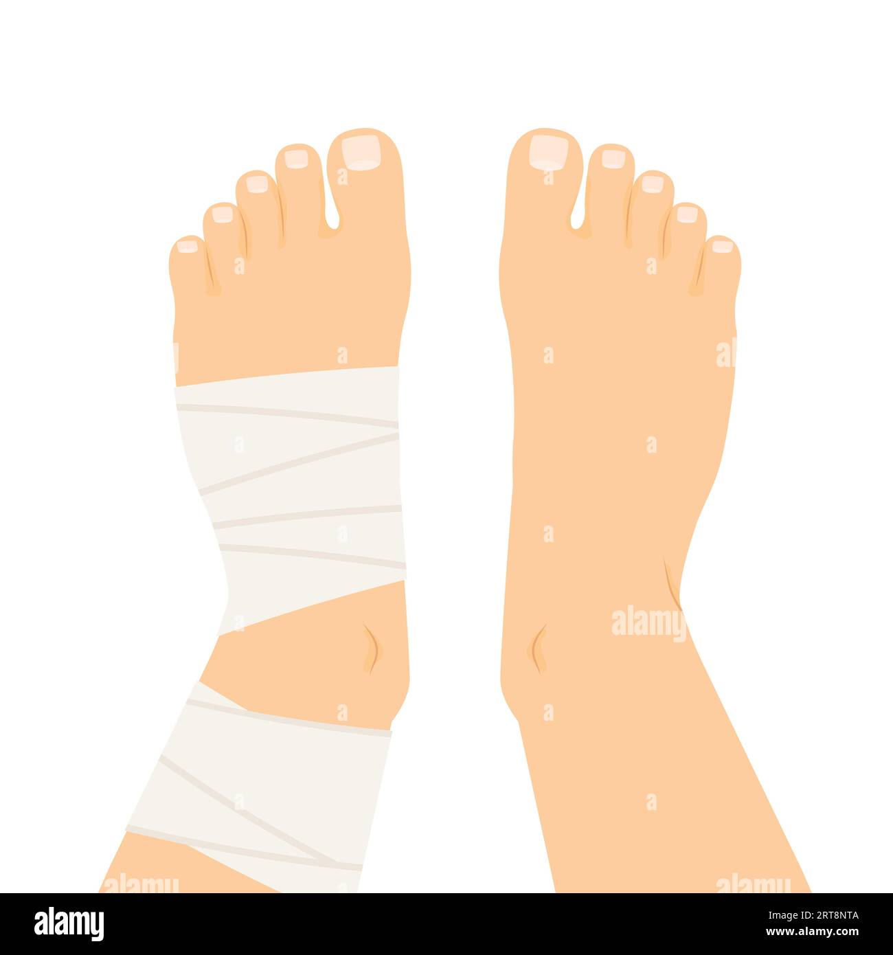 bandage de compression enroulé autour de la cheville tordue - illustration vectorielle Illustration de Vecteur