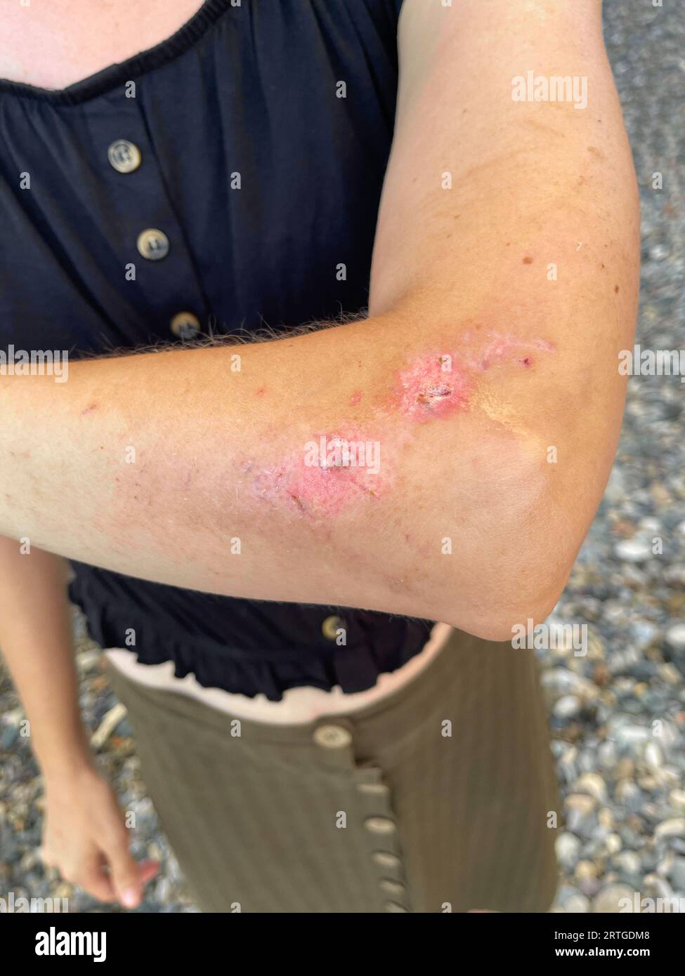 Femme avec une cicatrice au bras après un accident de voiture Banque D'Images