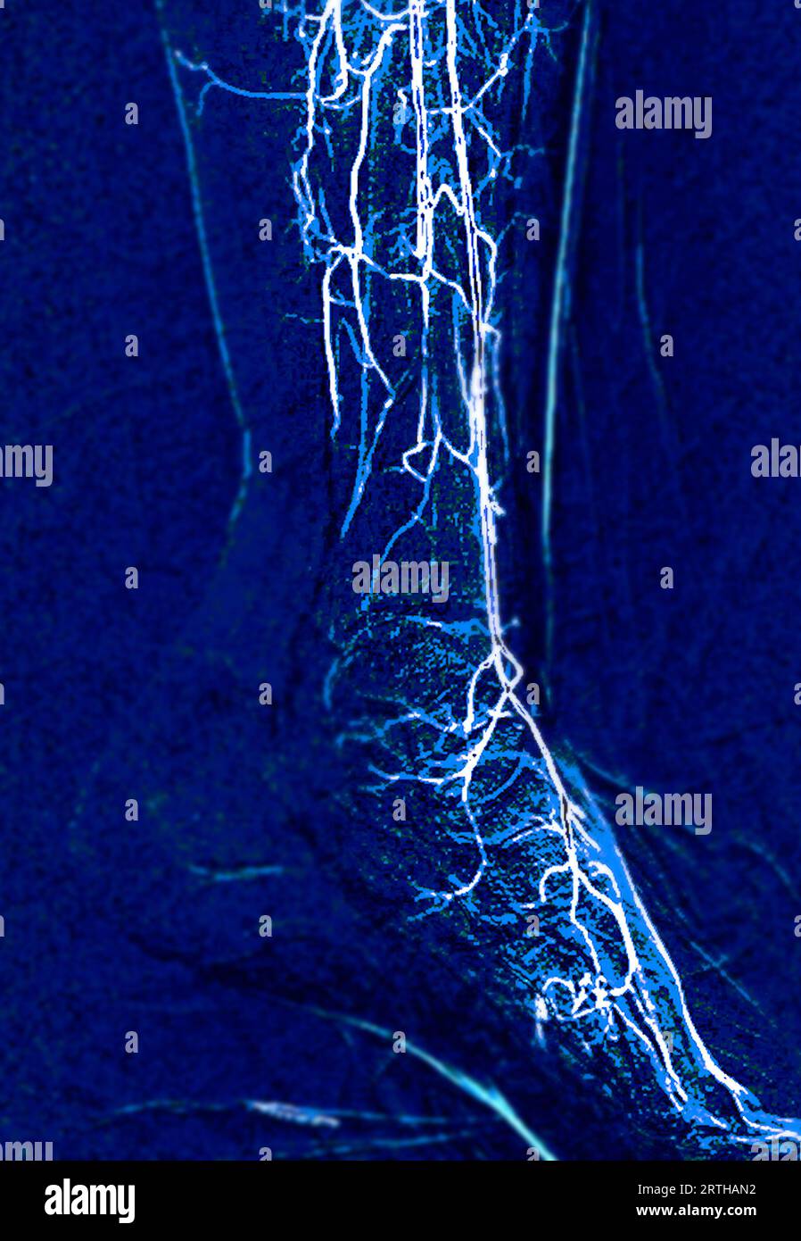 Angiorgame du pied ou angiographie plantaire montrant les artères plantaire et tarsienne au niveau du pied. Banque D'Images
