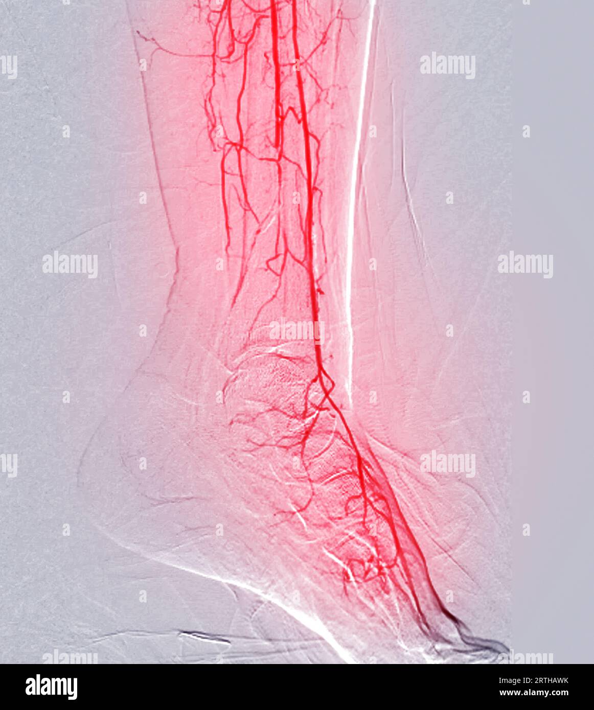Angiorgame du pied ou angiographie plantaire montrant les artères plantaire et tarsienne au niveau du pied. Banque D'Images
