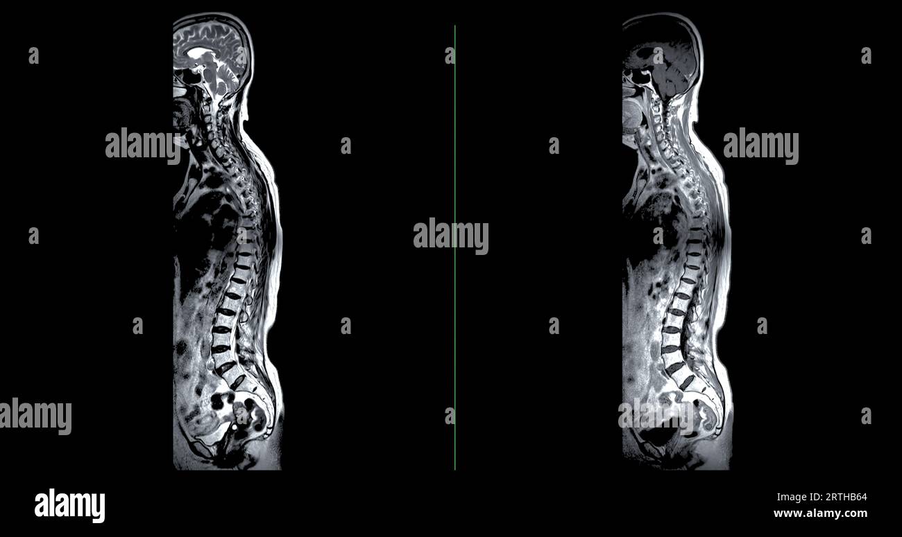 Examen IRM de la colonne vertébrale entière pour le diagnostic de la compression de la moelle épinière. Banque D'Images