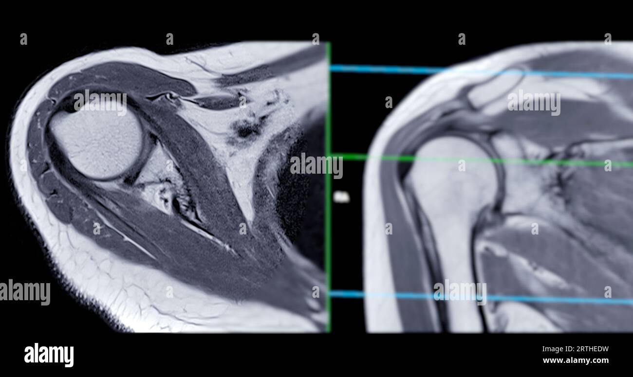 Imagerie par résonance magnétique ou IRM de l'articulation de l'épaule pour le diagnostic de douleur à l'épaule. Banque D'Images