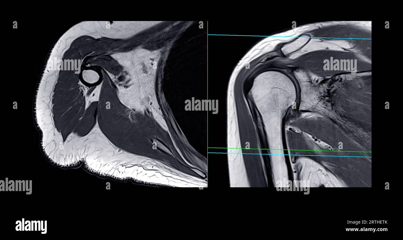 Imagerie par résonance magnétique ou IRM de l'articulation de l'épaule pour le diagnostic de douleur à l'épaule. Banque D'Images