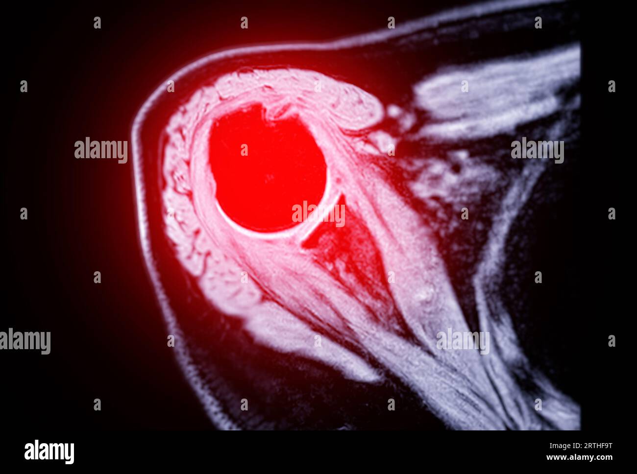 Imagerie par résonance magnétique ou IRM de l'articulation de l'épaule pour le diagnostic de douleur à l'épaule. Banque D'Images