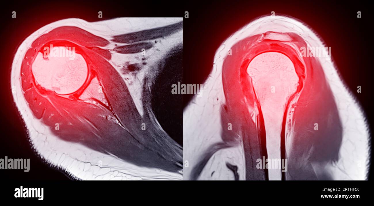 Imagerie par résonance magnétique ou IRM de l'articulation de l'épaule pour le diagnostic de douleur à l'épaule. Banque D'Images