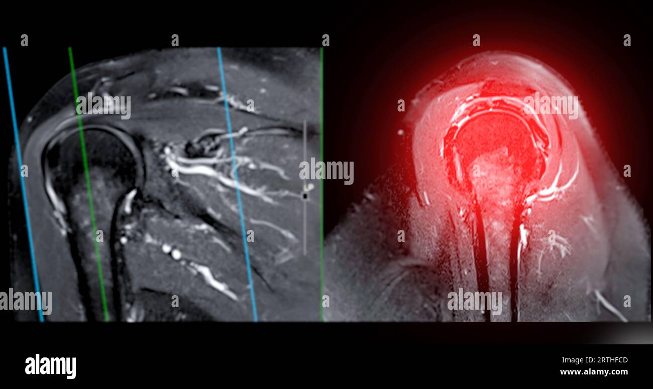 Imagerie par résonance magnétique ou IRM de l'articulation de l'épaule pour le diagnostic de douleur à l'épaule. Banque D'Images