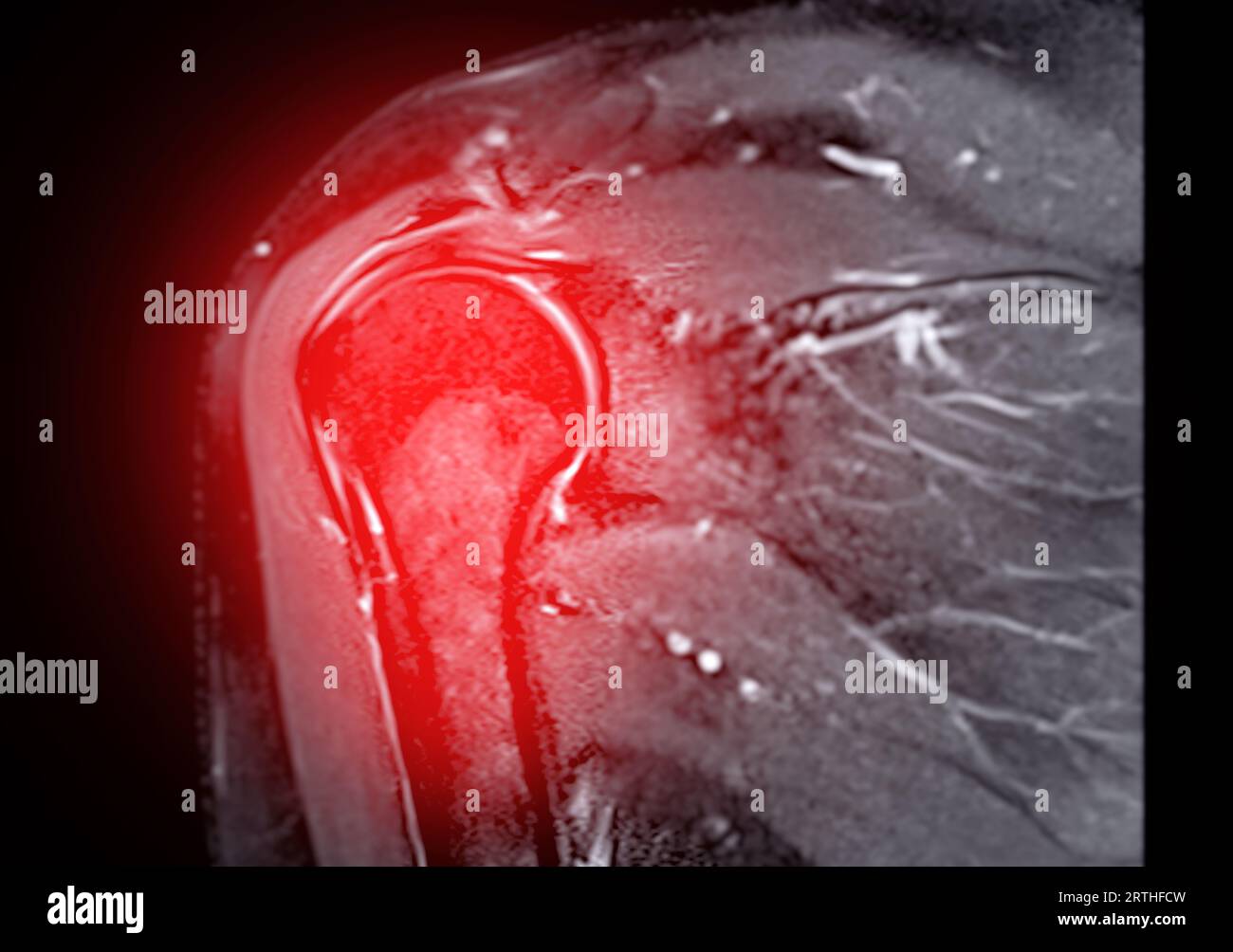 Imagerie par résonance magnétique ou IRM de l'articulation de l'épaule pour le diagnostic de douleur à l'épaule. Banque D'Images