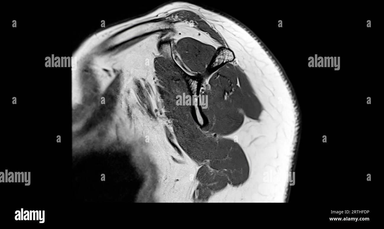 Imagerie par résonance magnétique ou IRM de l'articulation de l'épaule pour le diagnostic de douleur à l'épaule. Banque D'Images