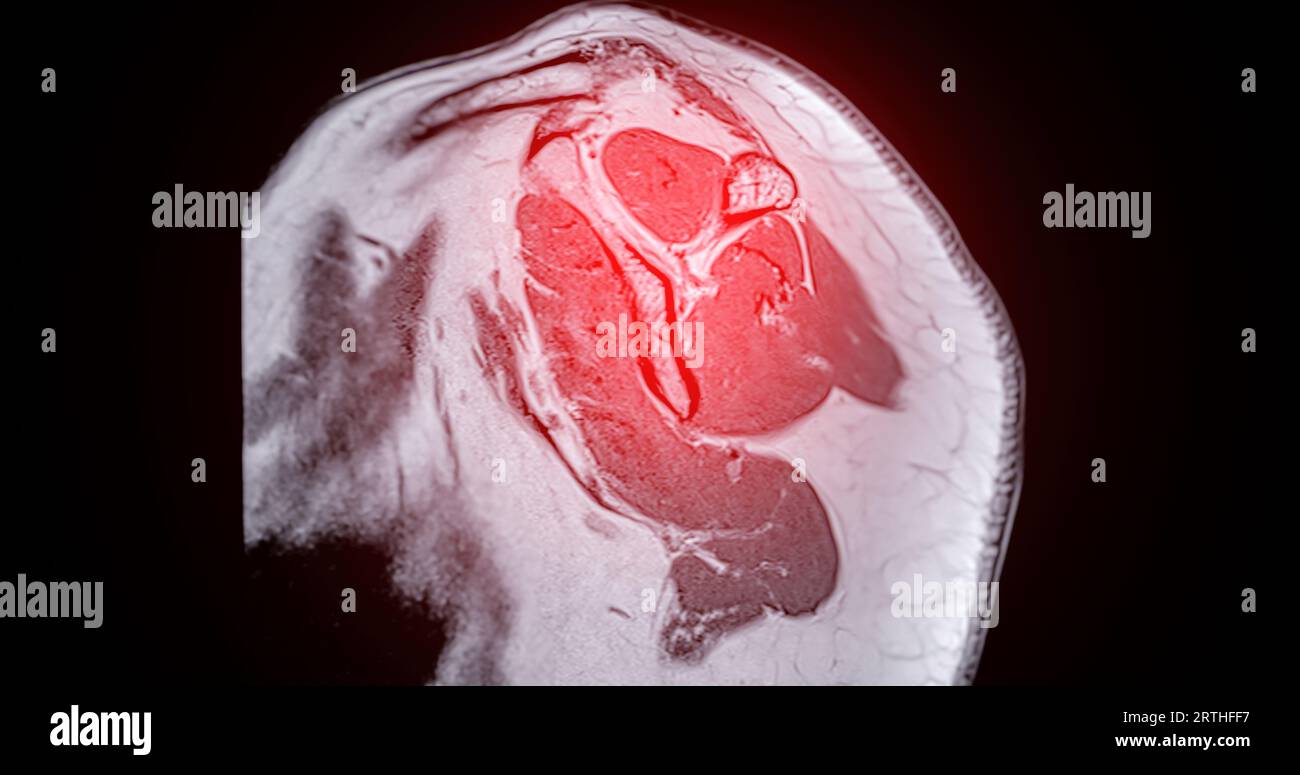 Imagerie par résonance magnétique ou IRM de l'articulation de l'épaule pour le diagnostic de douleur à l'épaule. Banque D'Images