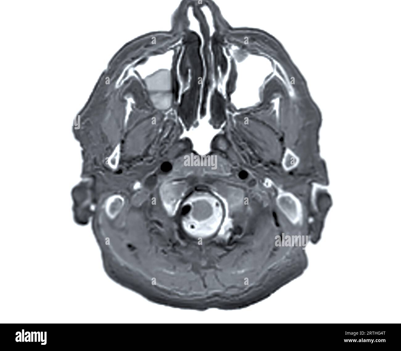 Vue axiale IRM du scanner cérébral pour détecter les maladies cérébrales telles que les accidents vasculaires cérébraux, les tumeurs cérébrales et les infections. Banque D'Images