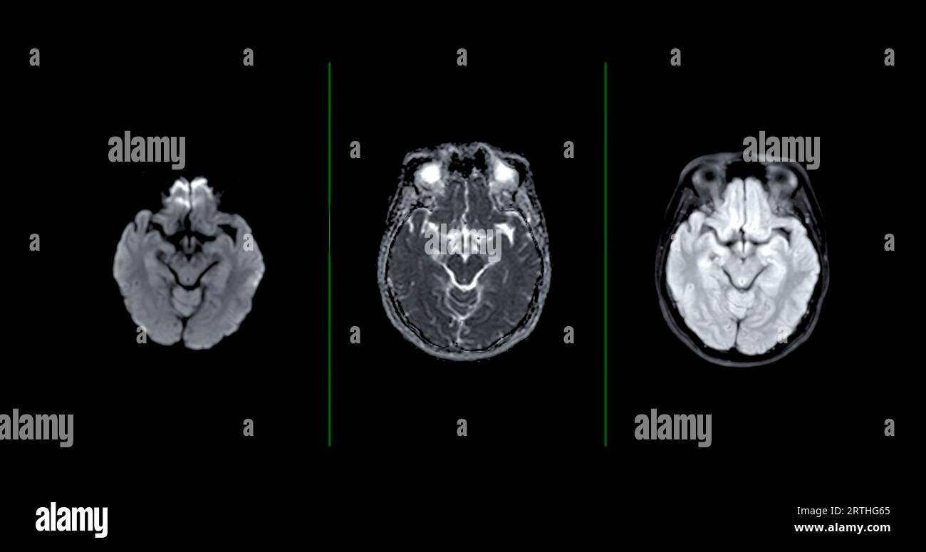 Technique de diffusion axiale d'IRM de balayage de cerveau pour détecter les maladies de cerveau sush comme maladie d'accident vasculaire cérébral, tumeurs de cerveau et infections. Banque D'Images