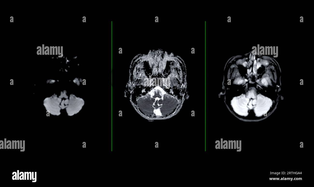 Technique de diffusion axiale d'IRM de balayage de cerveau pour détecter les maladies de cerveau sush comme maladie d'accident vasculaire cérébral, tumeurs de cerveau et infections. Banque D'Images