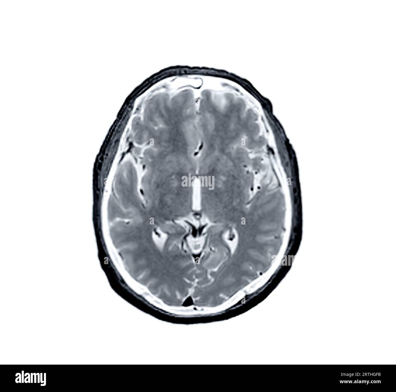 Vue axiale IRM du scanner cérébral pour détecter les maladies cérébrales telles que les accidents vasculaires cérébraux, les tumeurs cérébrales et les infections. Banque D'Images