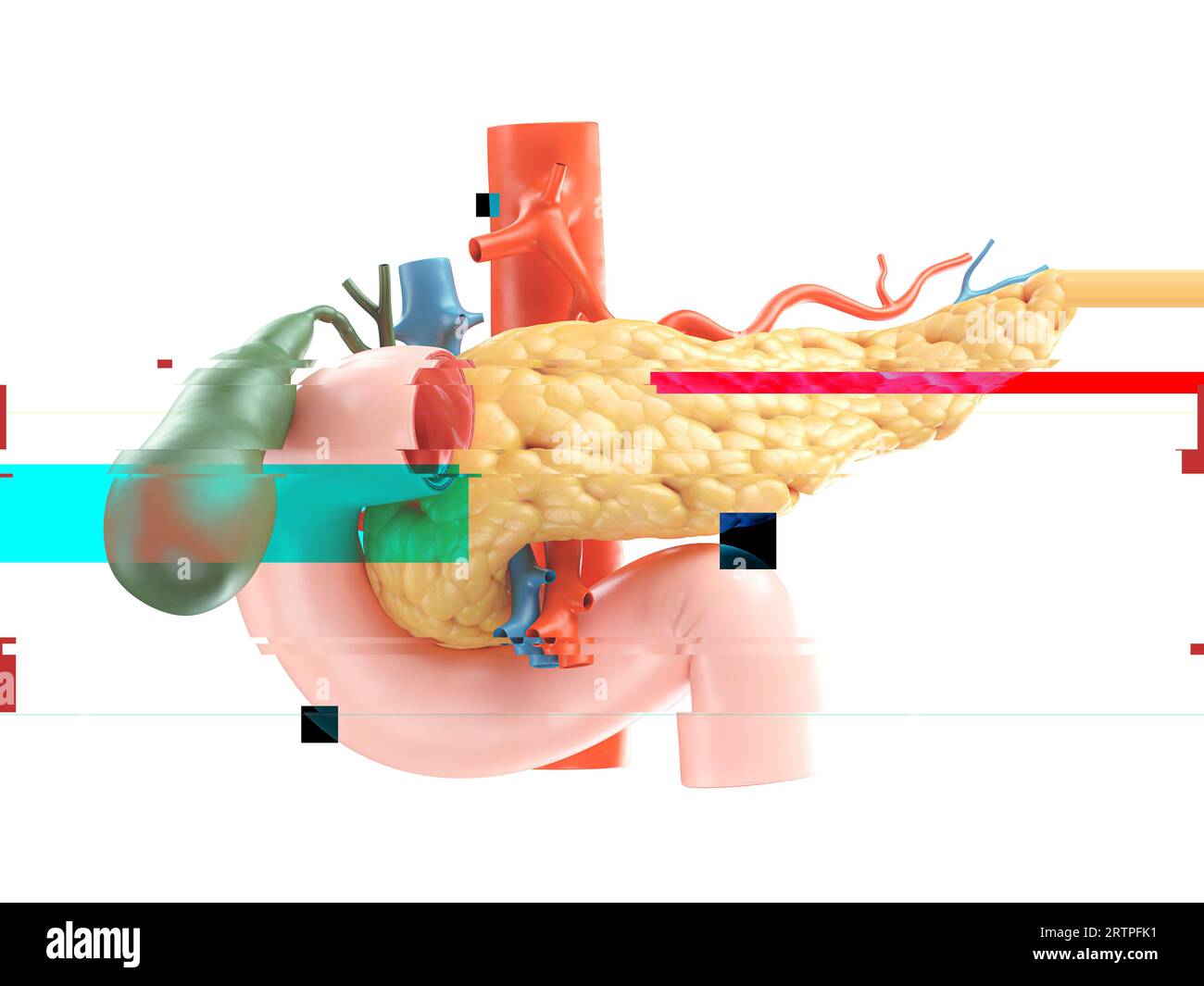 Illustration réaliste 3d du modèle anatomique du pancréas humain, du duodénum et de la vésicule biliaire avec effet de pépin, concept d'échec Banque D'Images