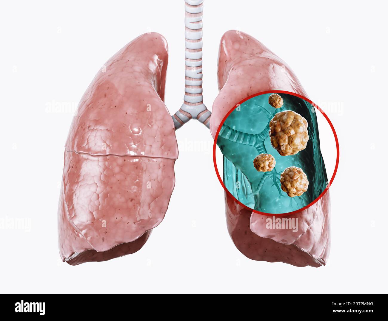 Poumons humains endommagés par le cancer. 3d illustration d'un poumon avec tissu cancéreux Banque D'Images