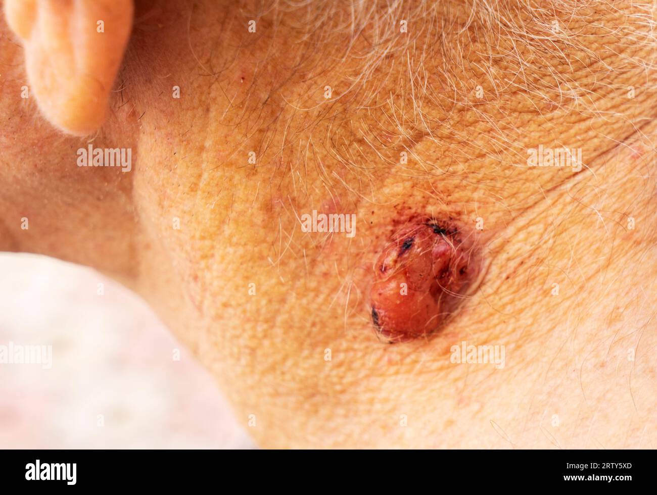 Un grand polype , une verrue , une taupe sur le cou d'un homme . taupe de papillome sur la peau humaine, macro shot, concept de santé, soins de la peau et risque de cancer. Banque D'Images