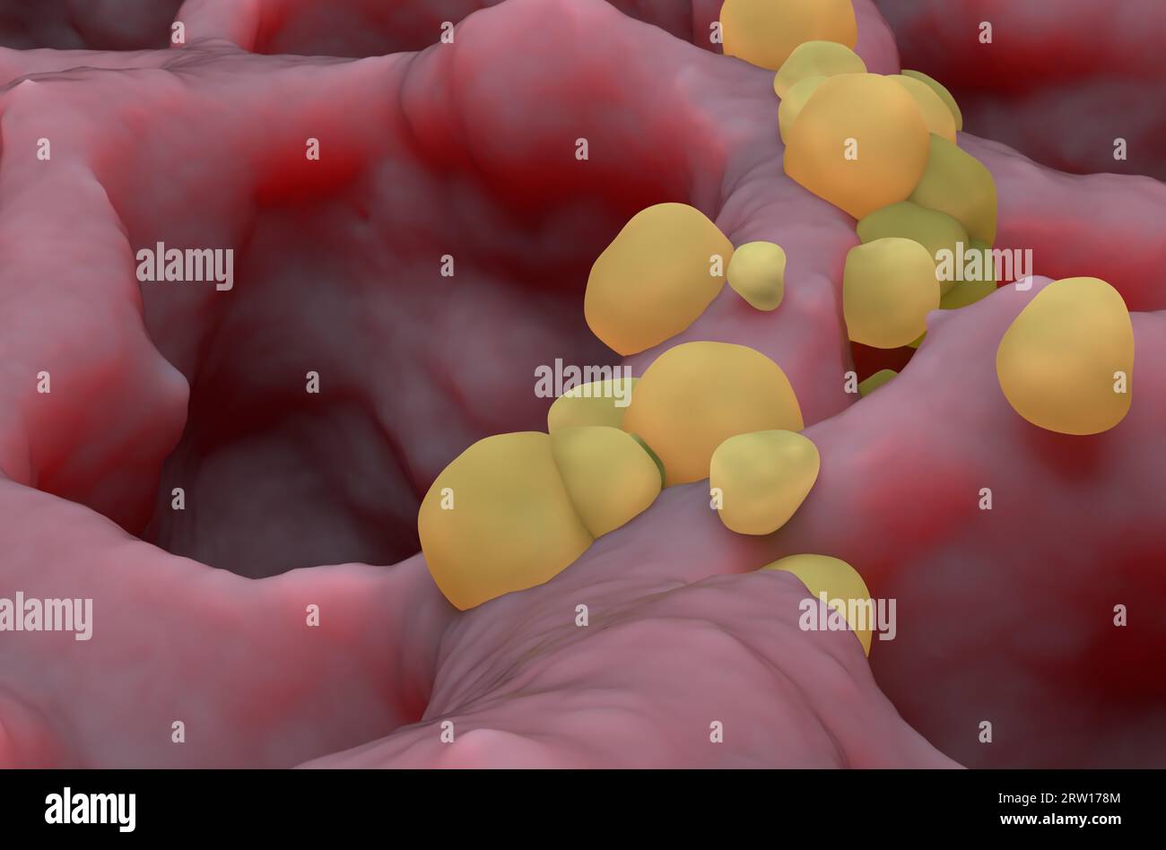 Petites tumeurs cancéreuses sur le tissu pulmonaire : cancer du poumon (LC) - vue en gros plan illustration 3d. Banque D'Images