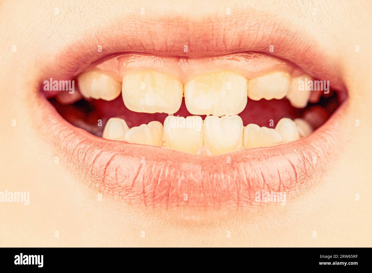 Bouche ouverte du patient enfant montrant des caries dentaires caries. Mauvais enfant de dents