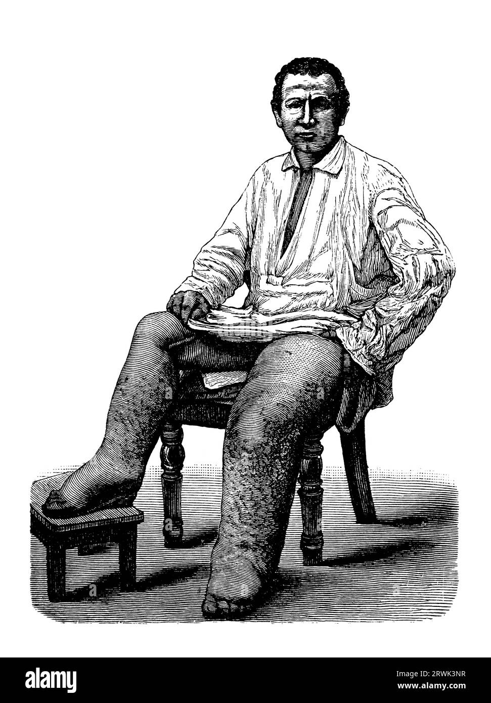 Homme souffrant d'Elephantiasis, une maladie qui se caractérise par l'épaississement de la peau et des tissus sous-jacents, en particulier dans les jambes, mâle Banque D'Images