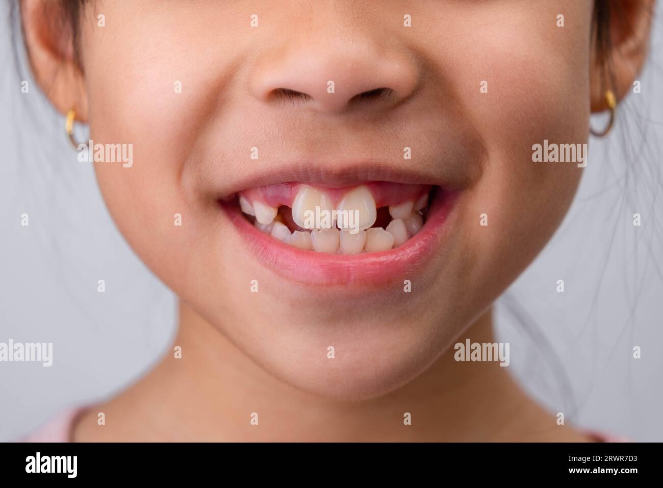 Gros plan de mignonne jeune fille souriant large, montrant l'espace vide avec la croissance des premières dents avant. Petite fille avec un grand sourire et des dents de lait manquantes. Denta Banque D'Images