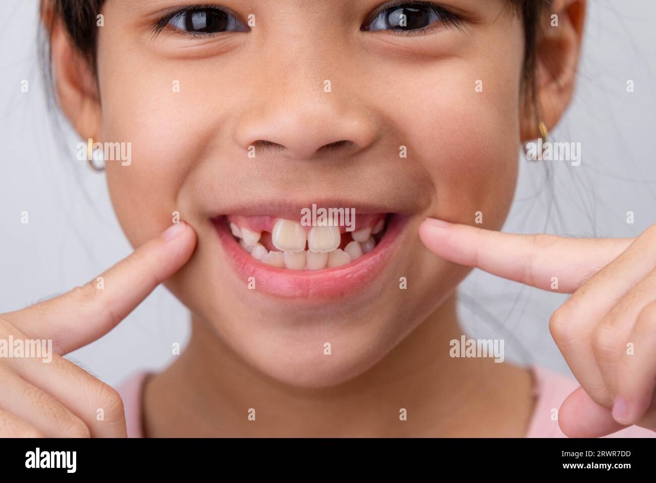 Gros plan de mignonne jeune fille souriant large, montrant l'espace vide avec la croissance des premières dents avant. Petite fille avec un grand sourire et des dents de lait manquantes. Denta Banque D'Images