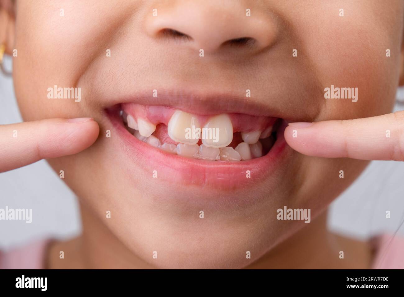 Gros plan de mignonne jeune fille souriant large, montrant l'espace vide avec la croissance des premières dents avant. Petite fille avec un grand sourire et des dents de lait manquantes. Denta Banque D'Images