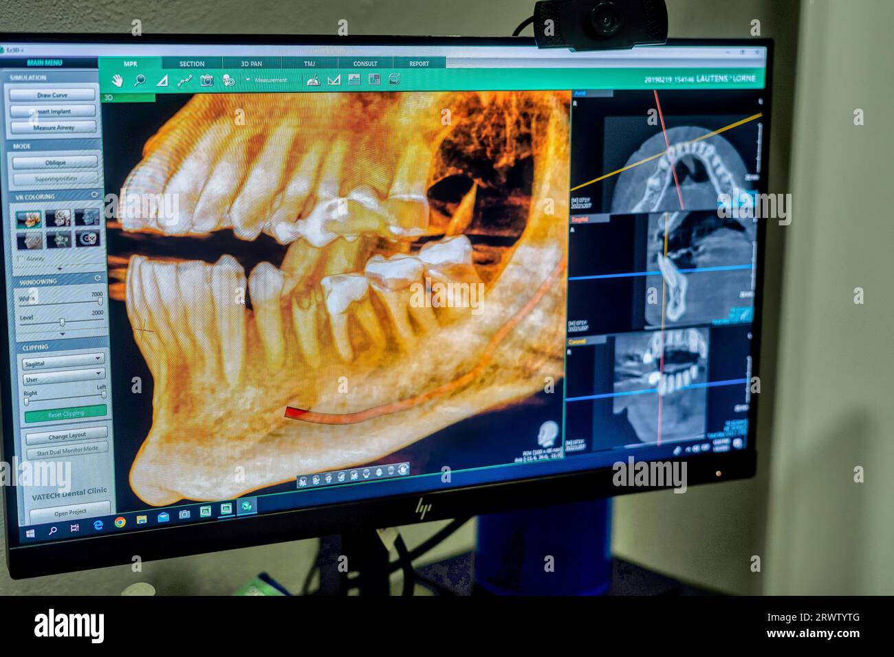 L'invention concerne un écran d'ordinateur affichant une image rendue en 3D d'une bouche humaine avec un modèle de dent placé devant celle-ci Banque D'Images