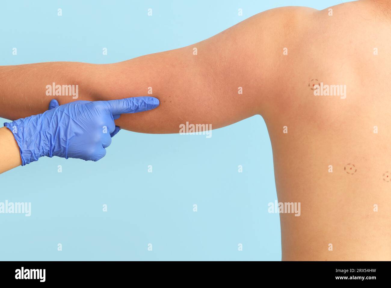 Dermatologue pointant vers les taupes sur le bras du jeune homme sur fond bleu, vue arrière Banque D'Images