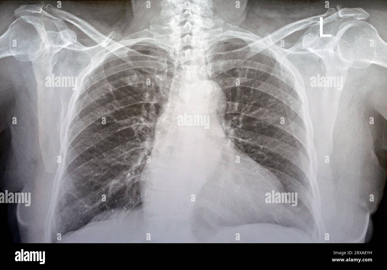 Radiographie thoracique simple d'une vieille femme avec étude presque normale des os, des poumons et du cœur, cavité thoracique normale, côtes et paroi, aucun signe de taches blanches ou Banque D'Images