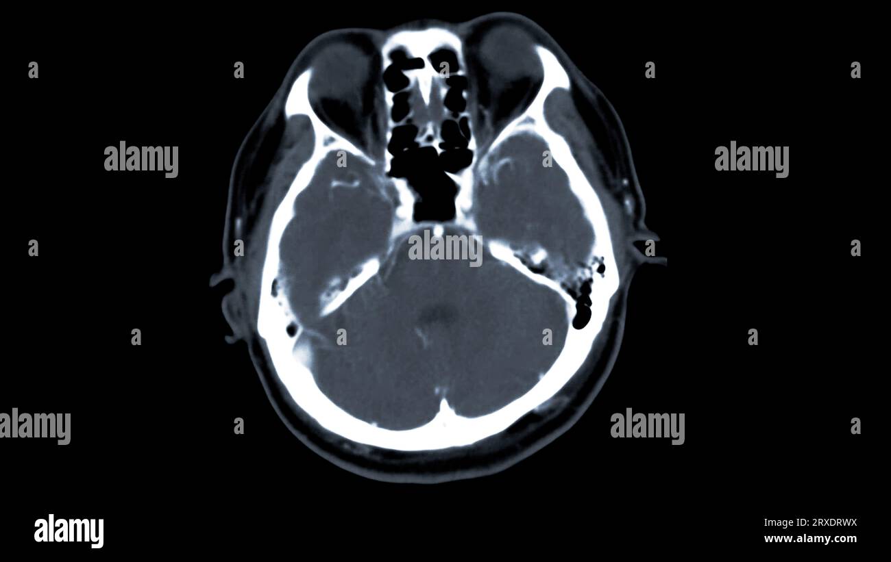 Scanner du cerveau avec le produit de contraste d'injection pour le diagnostic de tumeur cérébrale, les maladies d'AVC et les maladies vasculaires. Banque D'Images