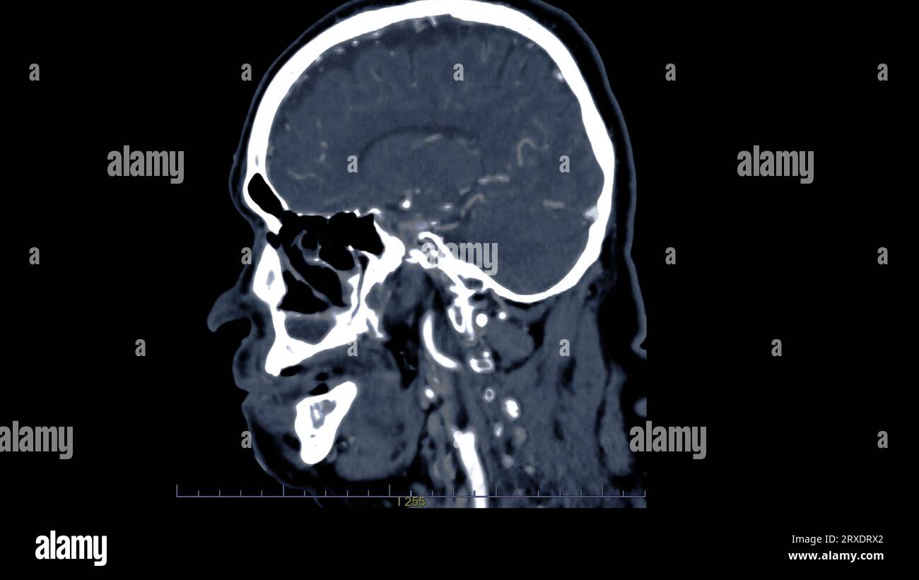 Scanner du cerveau avec le produit de contraste d'injection pour le diagnostic de tumeur cérébrale, les maladies d'AVC et les maladies vasculaires. Banque D'Images