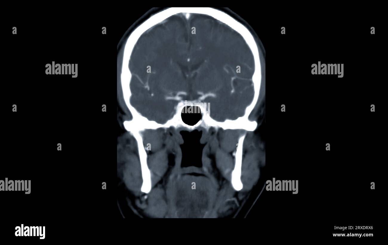 Scanner du cerveau avec le produit de contraste d'injection pour le diagnostic de tumeur cérébrale, les maladies d'AVC et les maladies vasculaires. Banque D'Images