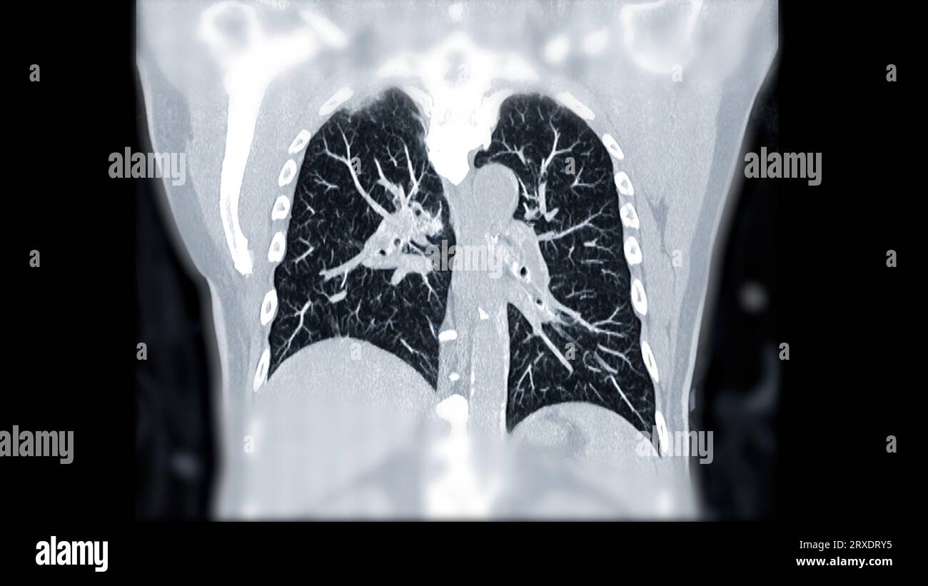CTPA ou CTA artère pulmonaire pour diagnostic d'embolie pulmonaire (EP), de cancer du poumon et de covid-19. . Banque D'Images