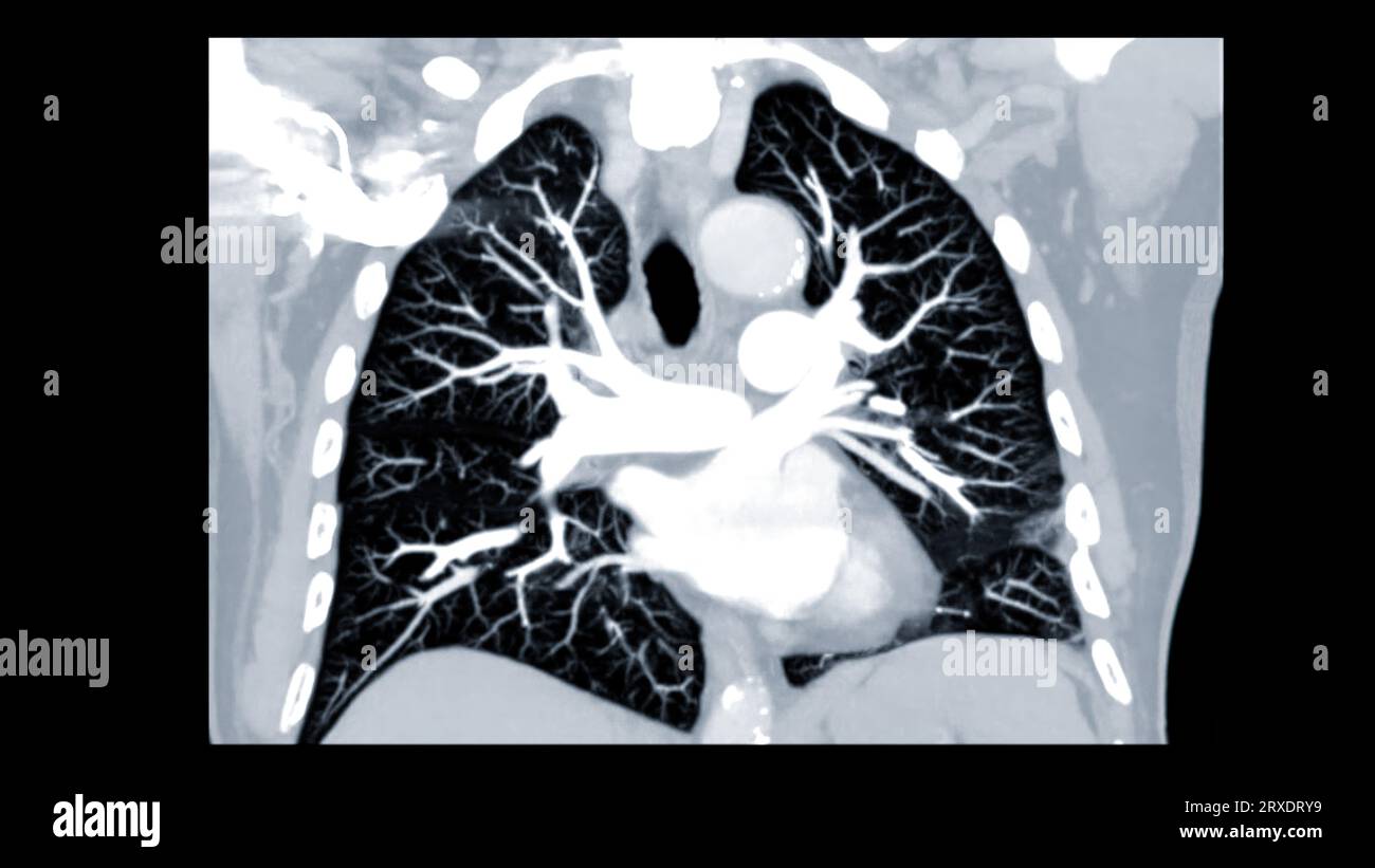 CTPA ou CTA artère pulmonaire pour diagnostic d'embolie pulmonaire (EP), de cancer du poumon et de covid-19. . Banque D'Images