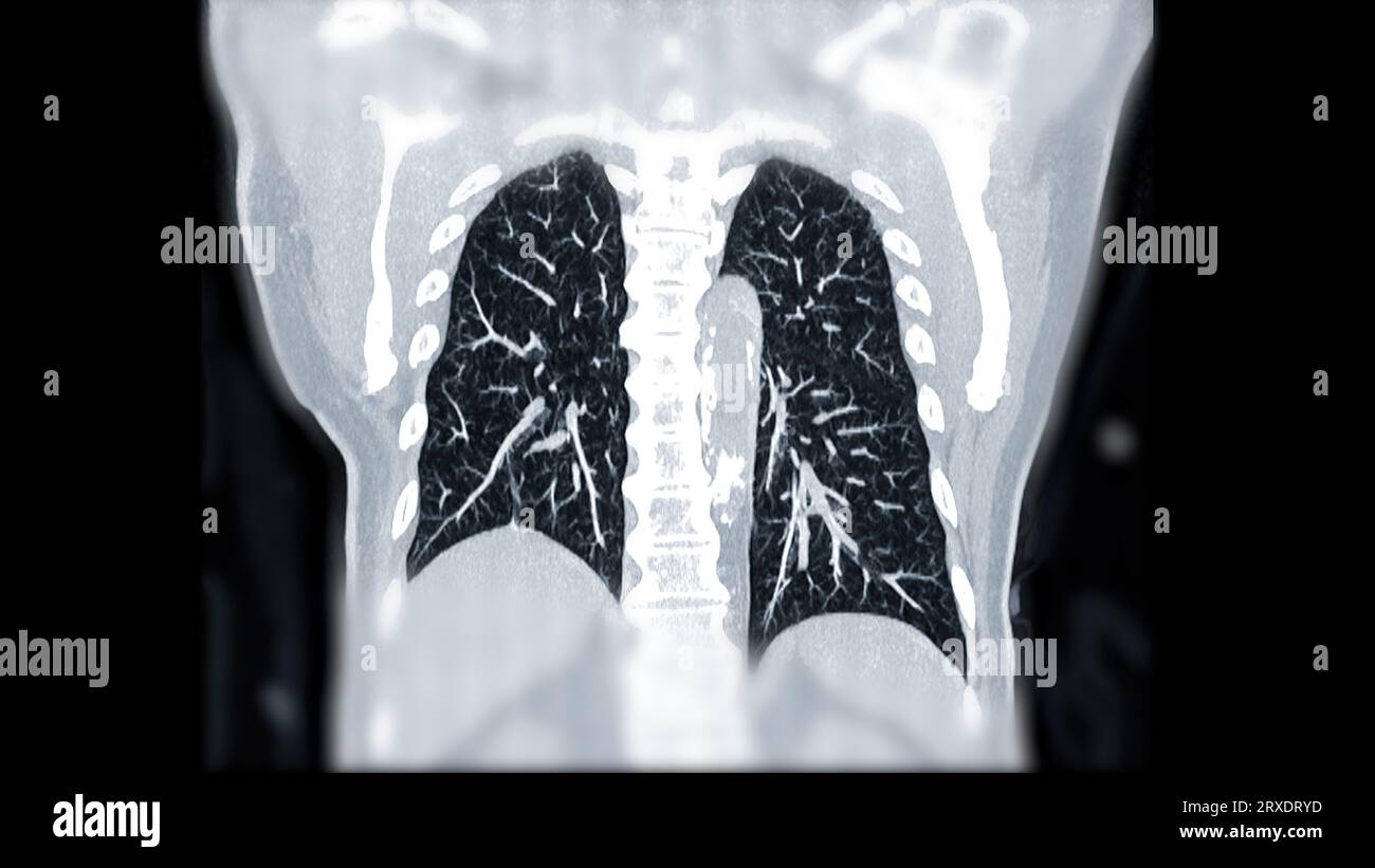 CTPA ou CTA artère pulmonaire pour diagnostic d'embolie pulmonaire (EP), de cancer du poumon et de covid-19. . Banque D'Images